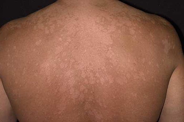 Ringworm: Here are the possible causes and home remedies for this skin infection