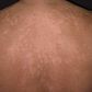 Ringworm: Here are the possible causes and home remedies for this skin infection