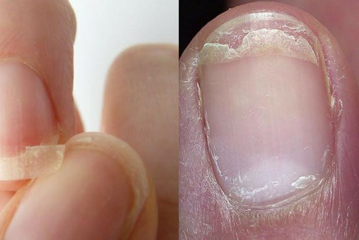 How you can naturally treat brittle nails. [Pinterest]