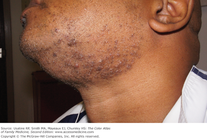 5 fast ways to treat razor bumps at home