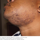 5 fast ways to treat razor bumps at home
