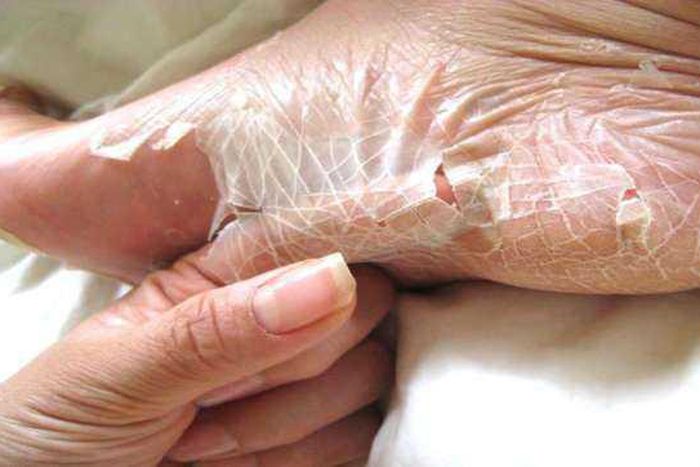 Here are the possible causes and home remedies for peeling skin (Scooper)