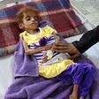 Yemen's conflict has triggered the world's worst humanitarian crisis, according to the United Nations