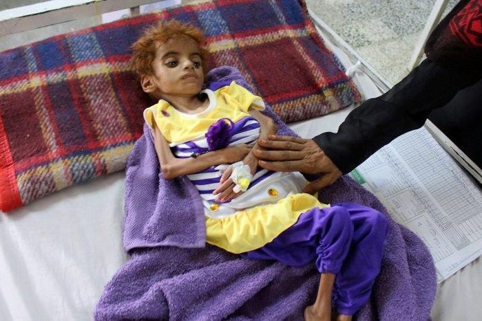 Yemen's conflict has triggered the world's worst humanitarian crisis, according to the United Nations