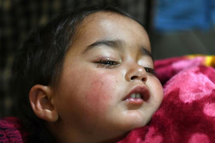 Hiba Jan was hit by a pellet fired from a pump-action gun in Kashmir