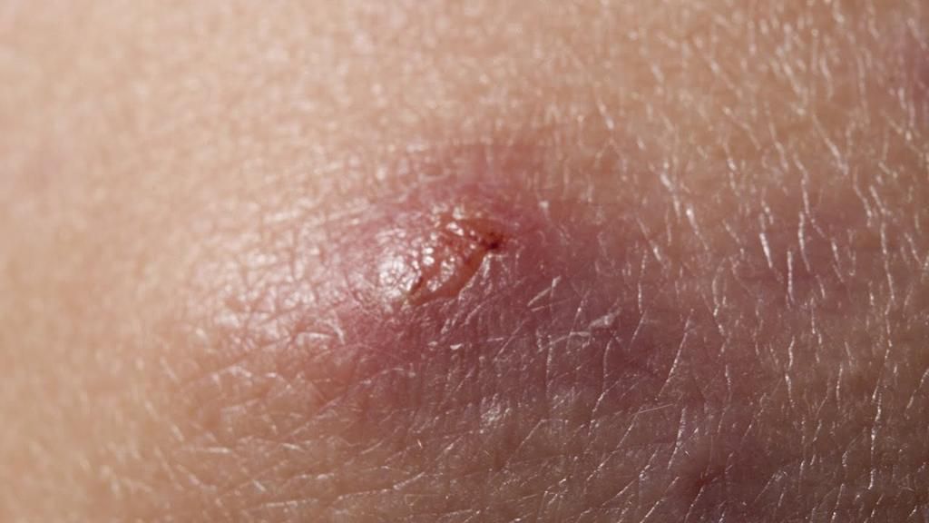 These home remedies will get rid of boils in no time