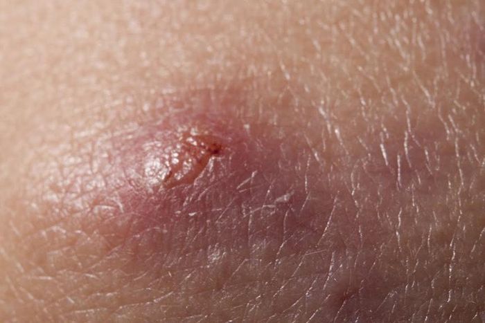 These home remedies will get rid of boils in no time