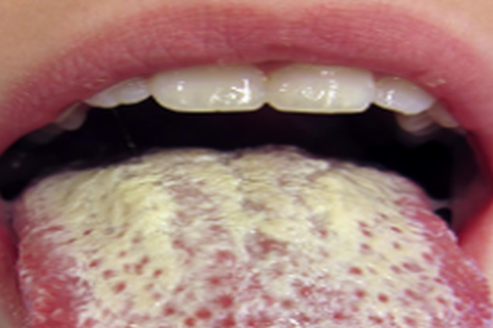 How to naturally get rid of Candida infection