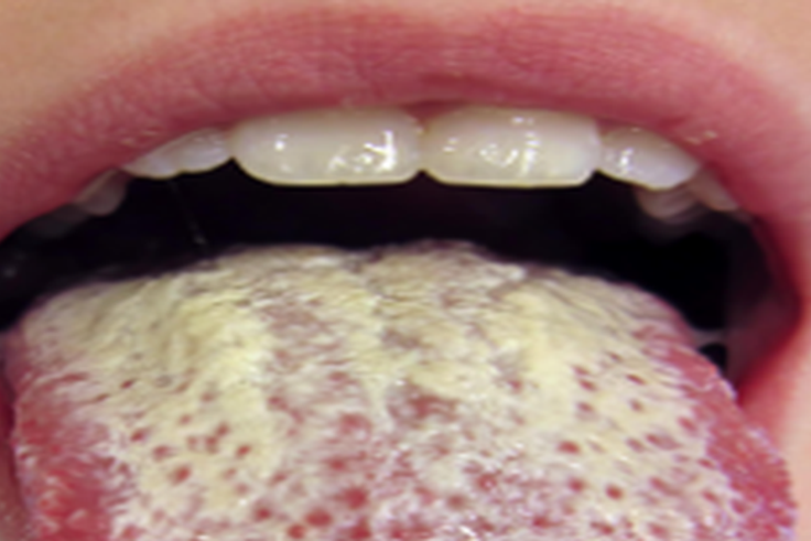How to naturally get rid of Candida infection