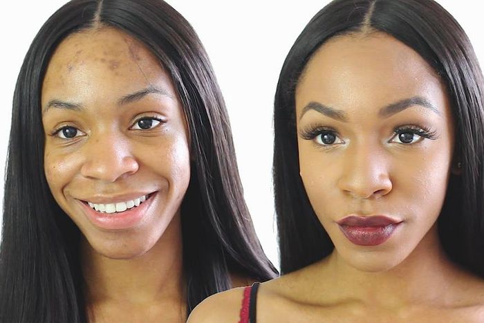 Ance Scars and other blemishes can be perfectly concealed with makeup but they are better treated