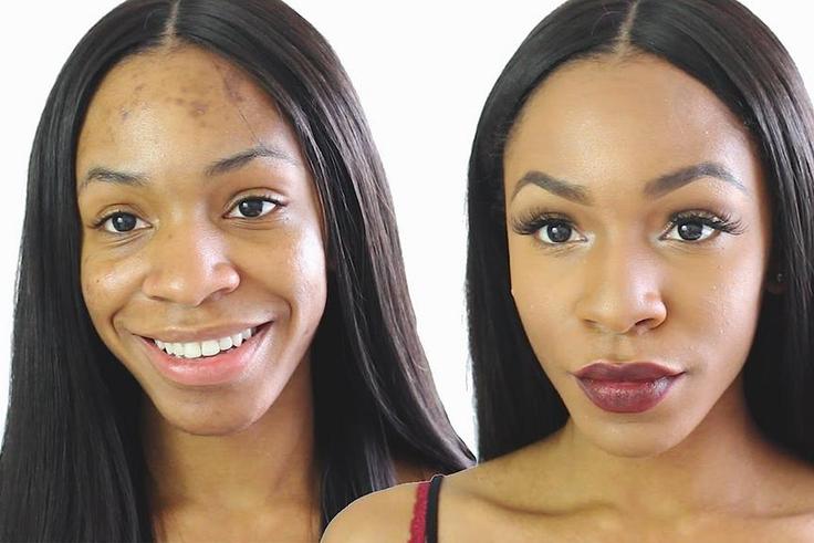 Ance Scars and other blemishes can be perfectly concealed with makeup but they are better treated