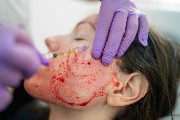 Wtf is a 'vampire facial' and is it even safe?