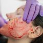 Wtf is a 'vampire facial' and is it even safe?