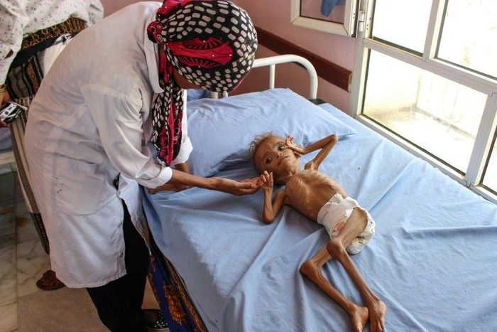 Save the Children says disruption to supplies coming through Yemen's embattled Hodeida port has put an extra one million children at risk of starvation, bringing the total to 5.2 million