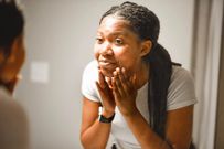 Fini les cicatrices ? Un nouveau traitement contre l’acné arrive