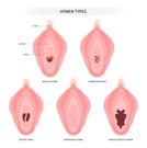 La virginité à tout prix : un réseau de vente d'hymen artificiel démantelé à Guédiawaye