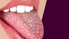 Le cancer de la langue : Qu'est ce que c'est?