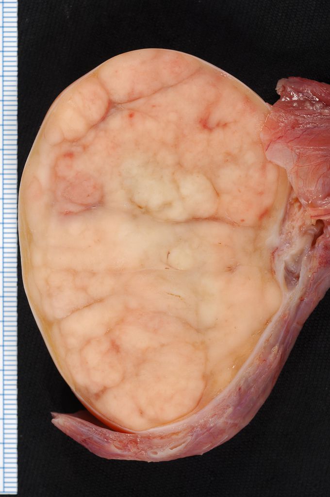 Ivre, il se coupe les testicules