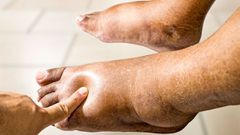 Ces médicaments courants qui vous font grossir