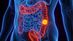 Cancer colorectal : ce signe aux toilettes doit vous alerter