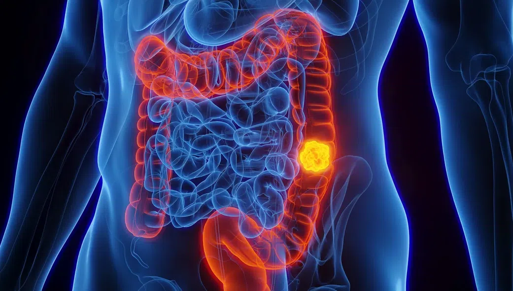 Cancer colorectal : ce signe aux toilettes doit vous alerter