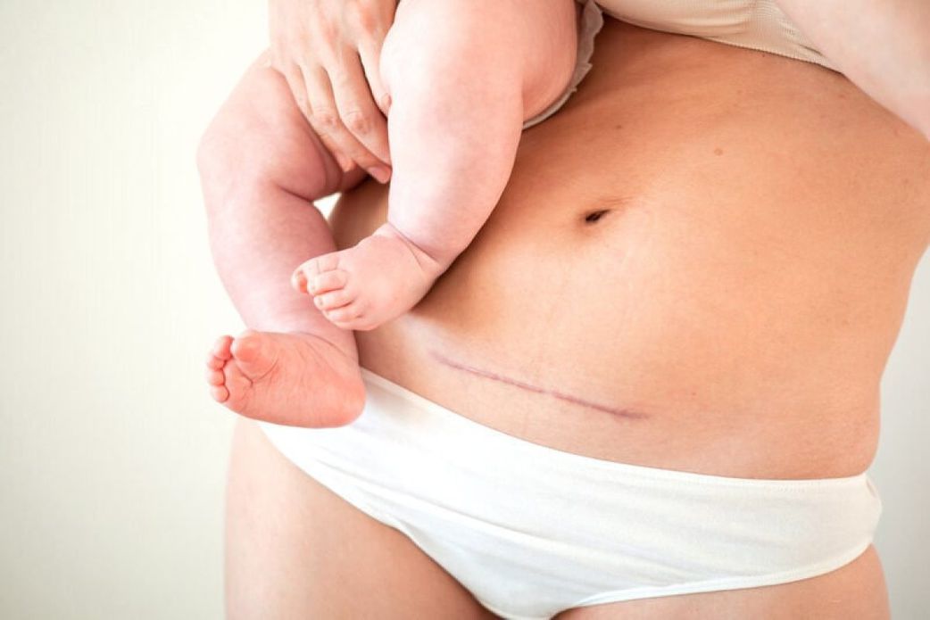Le ventre après l'accouchement : comment perdre son ventre de grossesse?
