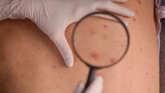 Comment reconnaître un cancer de la peau ?