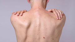 Comment reconnaître un cancer de la peau ?