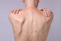 Comment reconnaître un cancer de la peau ?