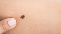 Comment reconnaître un cancer de la peau ?