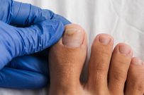 Vos ongles de pieds pourraient être un moyen de dépister précocement le cancer