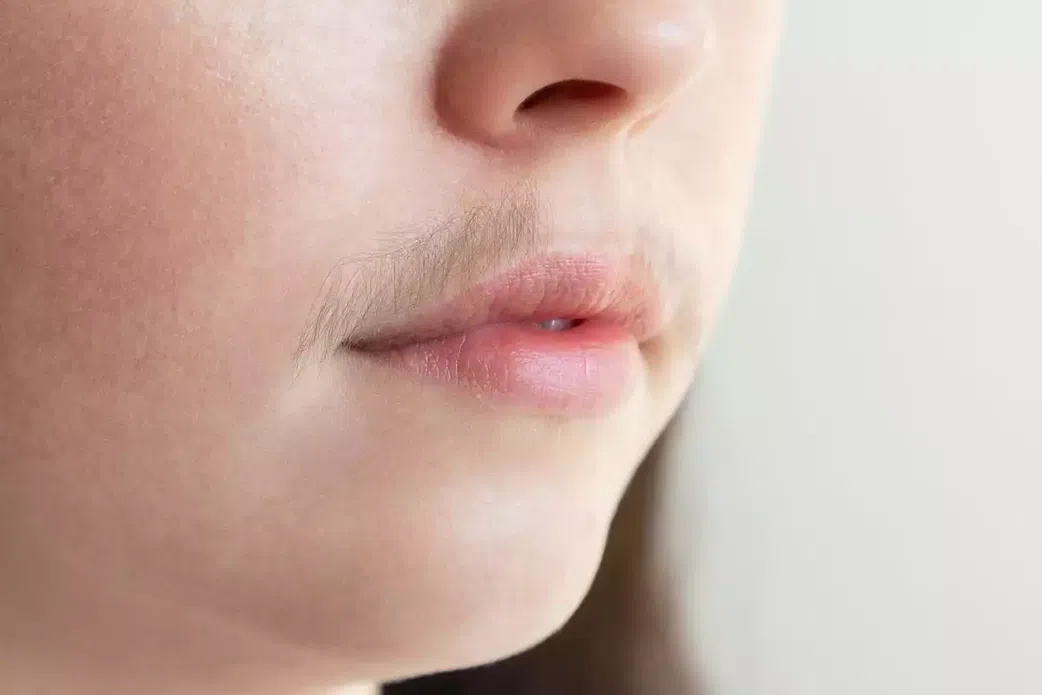 Moustache chez la femme : épilation ou décoloration ?