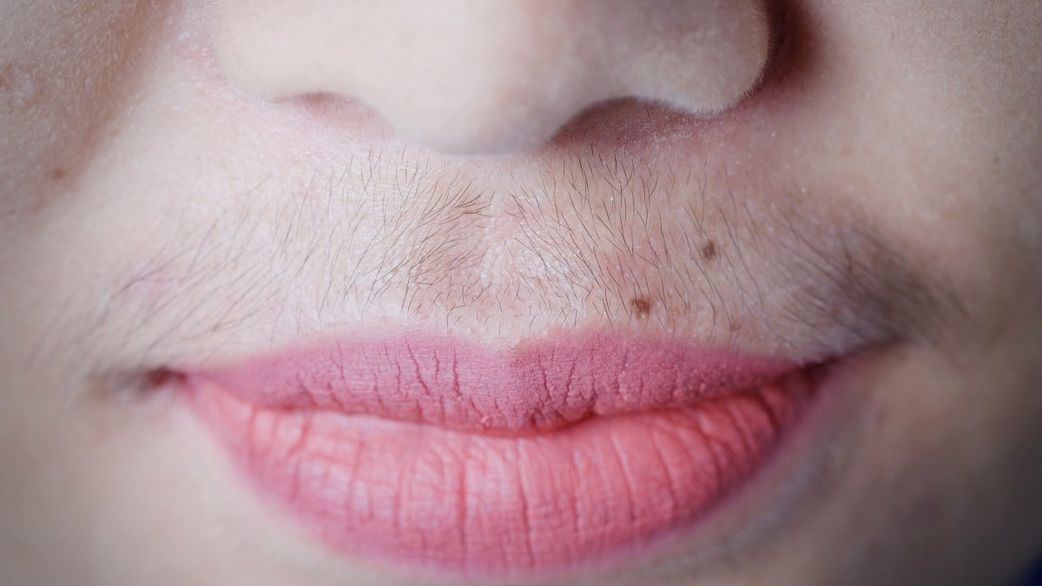 Moustache chez la femme : épilation ou décoloration ?