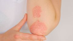 Le psoriasis qu'est ce que c'est?