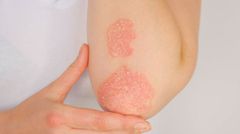 Le psoriasis qu'est ce que c'est?