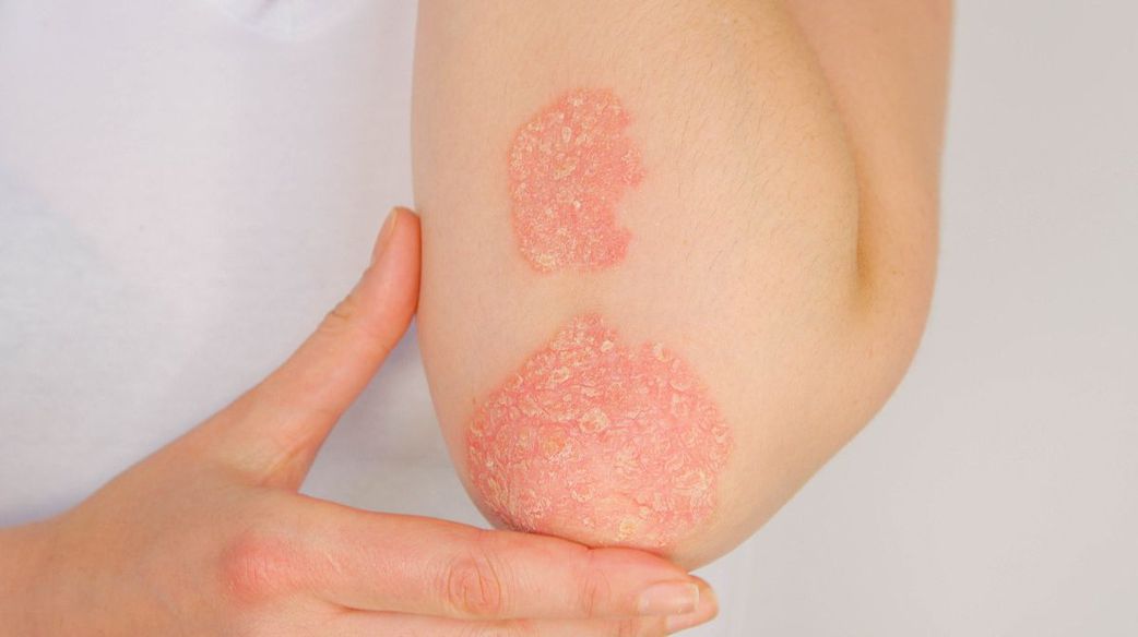 Le psoriasis qu'est ce que c'est?
