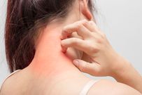Le psoriasis qu'est ce que c'est?