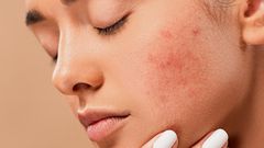 Le psoriasis qu'est ce que c'est?