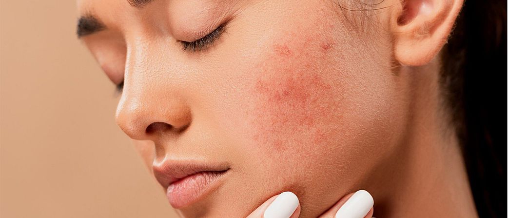Le psoriasis qu'est ce que c'est?