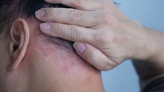 Le psoriasis qu'est ce que c'est?
