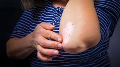 Le psoriasis qu'est ce que c'est?