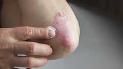 Le psoriasis qu'est ce que c'est?