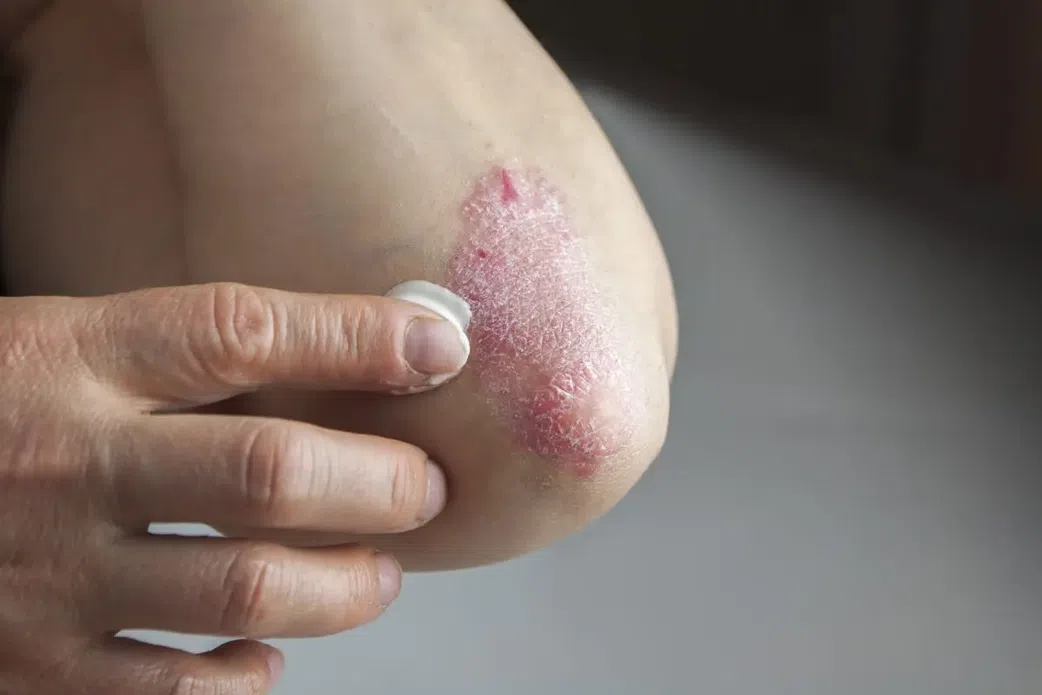 Le psoriasis qu'est ce que c'est?