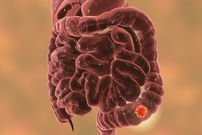 Le cancer du colon (cancer colorectal)