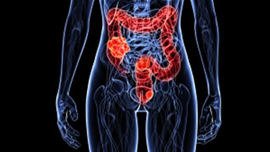 Le cancer du colon (cancer colorectal)