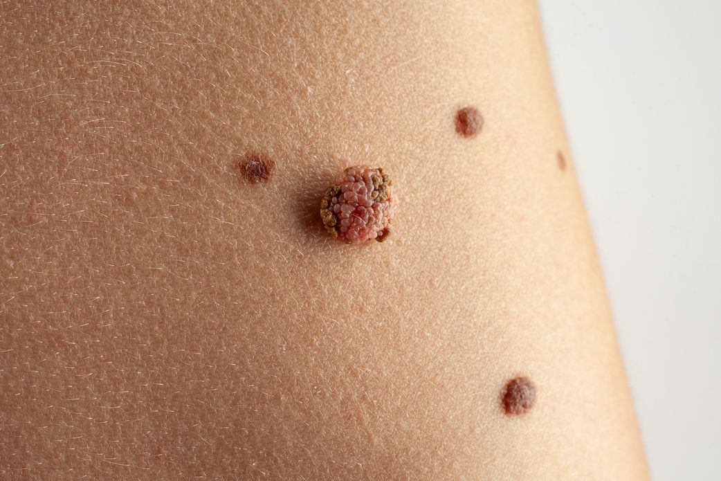Ne négligez pas cette tache noire sur votre ongle, ça pourrait être un cancer !