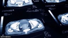Le cancer de la prostate est le quatrième cancer le plus souffert dans le monde, selon l'American Society of Clinical Oncology.