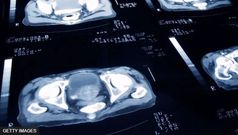 Le cancer de la prostate est le quatrième cancer le plus souffert dans le monde, selon l'American Society of Clinical Oncology.