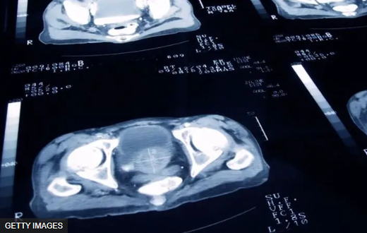 Le cancer de la prostate est le quatrième cancer le plus souffert dans le monde, selon l'American Society of Clinical Oncology.