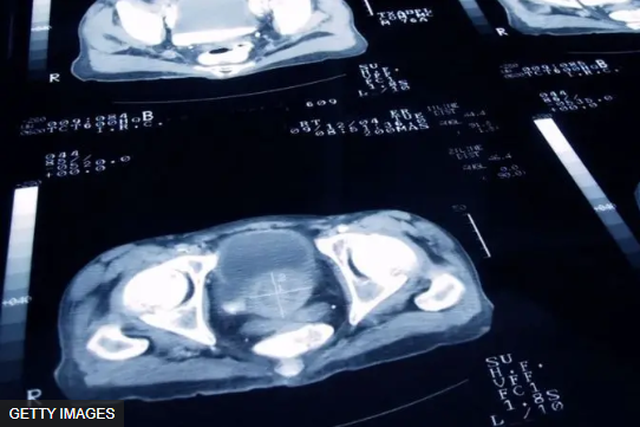 Le cancer de la prostate est le quatrième cancer le plus souffert dans le monde, selon l'American Society of Clinical Oncology.